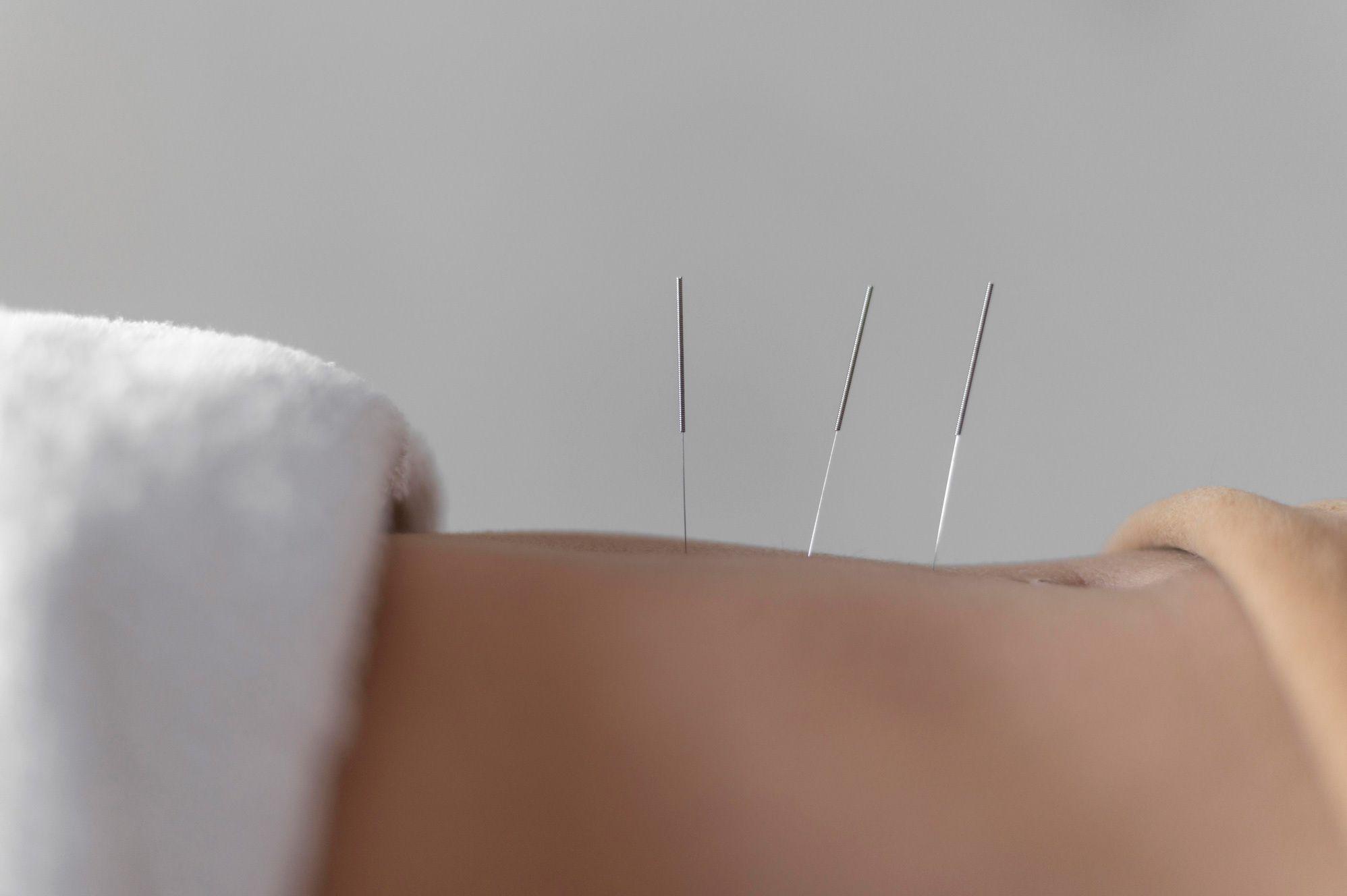 close-up-acupuncture-procedure.jpg